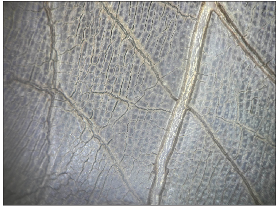 Dermoscopy from sole showing ‘leaf venation’ pattern (DermLite DL3N, non-polarised 10x).