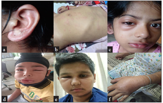 (a), (b) and (c) depict allergic/mast cell–mediated angioedema involving [a] ear lobe, [b] urticarial rash over the abdominal wall and [c] peri-orbital region, respectively (d), (e) and (f) depict bradykinin-mediated angioedema due to hereditary angioedema involving peri-orbital region [(d), (e)], [d] lips and [f] left hand.