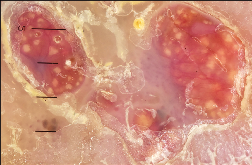 Non-polarised dermoscopic examination at 10× magnification of the nodular lesions revealed scattered yellowish granules of variable size, known as ‘grains’.