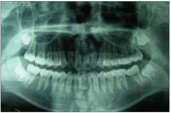 Panoramic radiographs of patient in Figure 1c showed hypodense shadows in the left mandibular central incisor apical region.