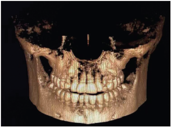3D reconstruction of a fistula under the right lower central incisor of the patient (1a).
