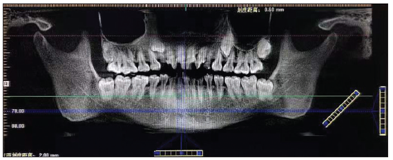 CBCT scan with a panoramic view of the patient (1a).