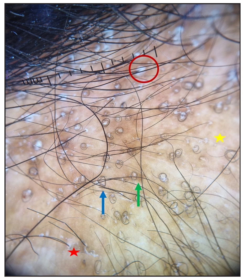 Trichoscopic image (DermLite DL4, x10) showing perifollicular scale (red circle), coiled hairs (blue arrow), loss of follicular ostia (yellow star), perifollicular pigmentation (green arrow) and interfollicular scaling (red star).