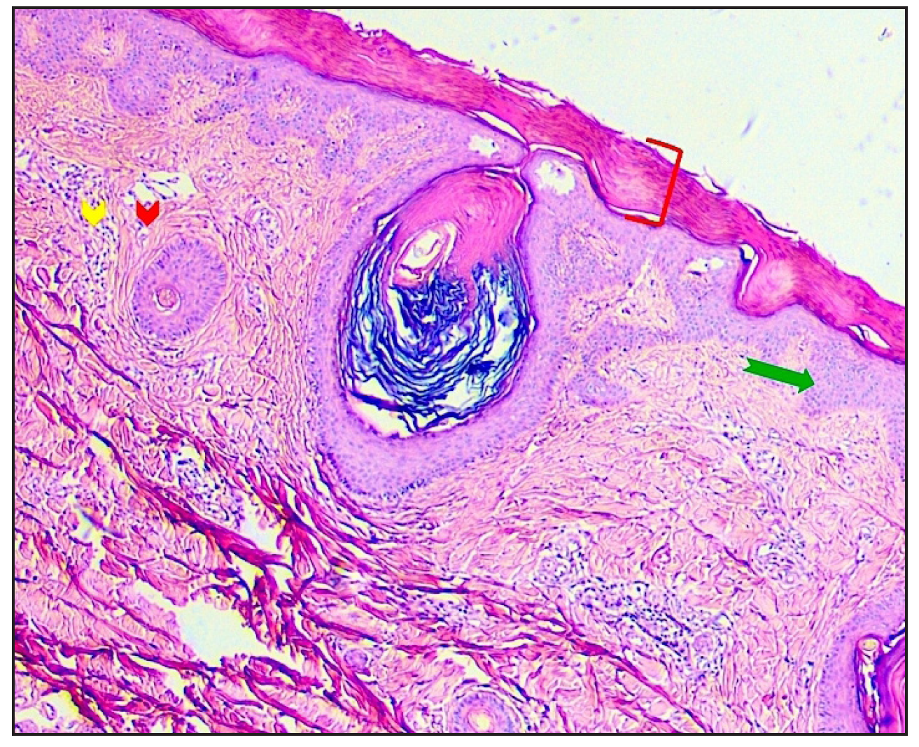 Histopathological image of scalp biopsy (Haematoxylin and eosin stain, 40x magnification) showing hyperkeratosis (red bracket), acanthosis (green arrow) and spongiosis. Anagen hair follicles in the dermis are accompanied by perifollicular fibrosis (red arrowhead) and inflammation consisting primarily of lymphocytes (yellow arrowhead) with no interface activity.