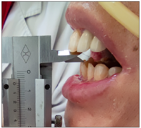 Mouth opening was severely limited and the distance between upper and lower central incisors was 6 mm.