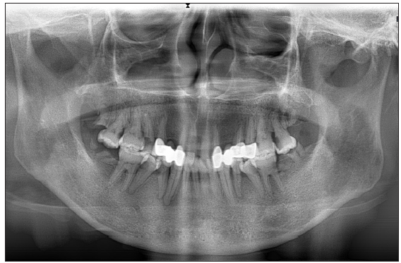 No evidence of an odontogenic fistula on panoramic radiograph.