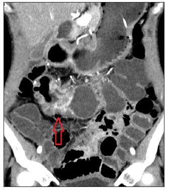 Computed tomography enterography revealed a volcano-like ulcer in the anastomosis region (red arrow).