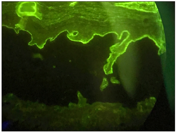 Indirect immunofluorescence on the salt-split skin showed positive with linear roof-bounded IgG (200x).