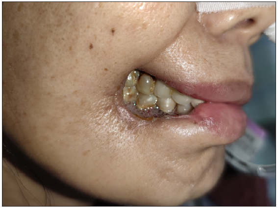 Transformation of the fistula following therapy: The inflammation was controlled within 10 days after the initiation of therapy.