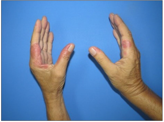 Improvement of neutrophilic dermatosis of dorsal hands after treatment.