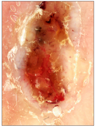 Dermoscopy showing blue ovoid nests and arborising vessels (DL4, polarising: 20×).