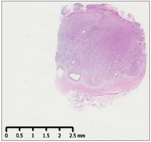 Multiple nests of basaloid cells originating from the epidermis and infiltrating into the dermis (Haematoxylin and eosin; 10×).