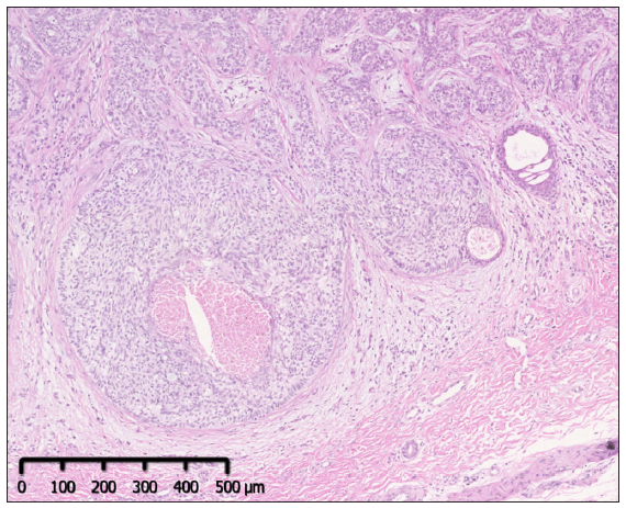 The basaloid cells at the periphery of aggregations were arranged in a palisade pattern (Haematoxylin and eosin; 50×).