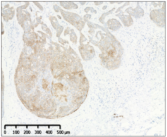 Positive BerEP4 staining of the tumour (Immunohistochemistry staining; 50×).