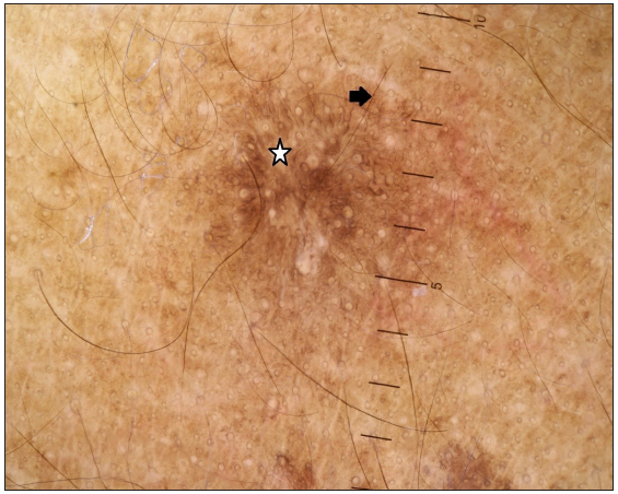 Fingerprint pattern on dermoscopy characterised by brown, fine, parallel structures (white star) and a background of homogeneous brown pigmentation (black arrow) (Heine 20T, polarised mode, 10x).