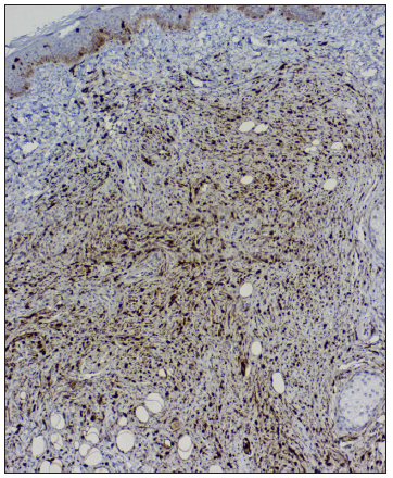 Tumour cells are immunopositive for S100 (IHC, 100x). (IHC: immunohistochemistry)