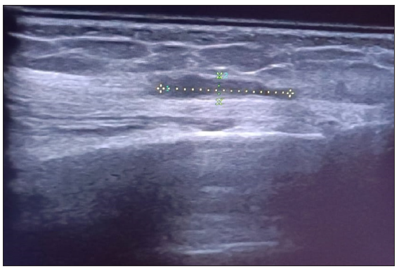 Multiple linear hypoechoic tracts (maximum 10 × 3mm) extending into perineural space along the nerve.