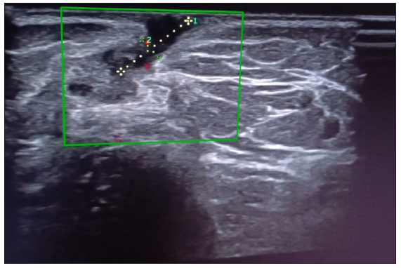 Hypoechoic tract (sinus) extending onto the skin surface (Green square highlights the selected area).