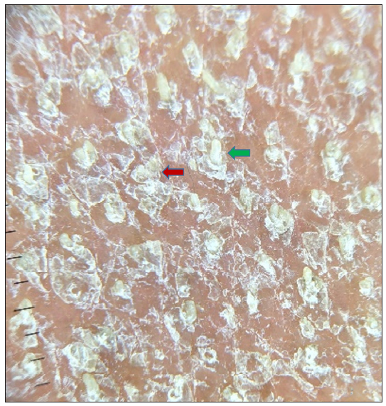 Dermoscopy (using Illuco IDS-1100, 10x, polarised mode) shows white keratotic follicular plugging (green arrow) and furfuraceous scaling (red arrow) against the background of erythema (before treatment).