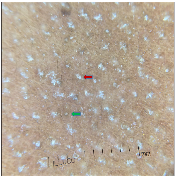 Dermoscopy (using Illuco IDS-1100, 10x, polarised mode) shows white keratotic follicular plugging (green arrow) and furfuraceous scaling (red arrow) against the background of erythema (three weeks after treatment).