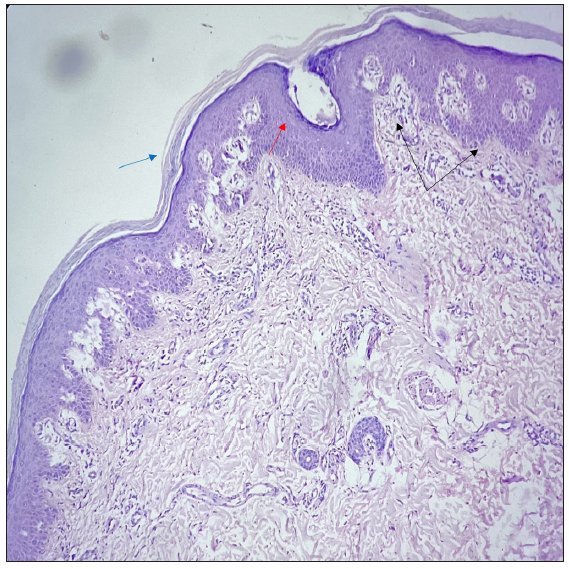 Histopathology showing hyperkeratosis, orthokeratosis alternating with parakeratosis (blue arrow), follicular plugging (red arrow), irregular acanthosis with broad rete ridges, thick suprapapillary plates (black arrows), and superficial perivascular lymphocytic infiltrate in the dermis (Haematoxylin and eosin, 20x).