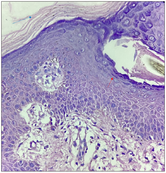 Histopathology showing hyperkeratosis, orthokeratosis alternating with parakeratosis (blue arrow), and follicular plugging (red arrow) (Haematoxylin and eosin, 40x).