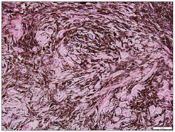 Dermis showed melanocytes and pigmented dendritic cells in a background of thick collagen bundles (Haematoxylin and Eosin, 200x)