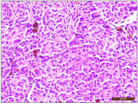 High power showed naevus cells with mild nuclear atypia, some cells showed intracytoplasmic melanin, and no mitosis/necrosis was noted (Haematoxylin and Eosin, 200x)