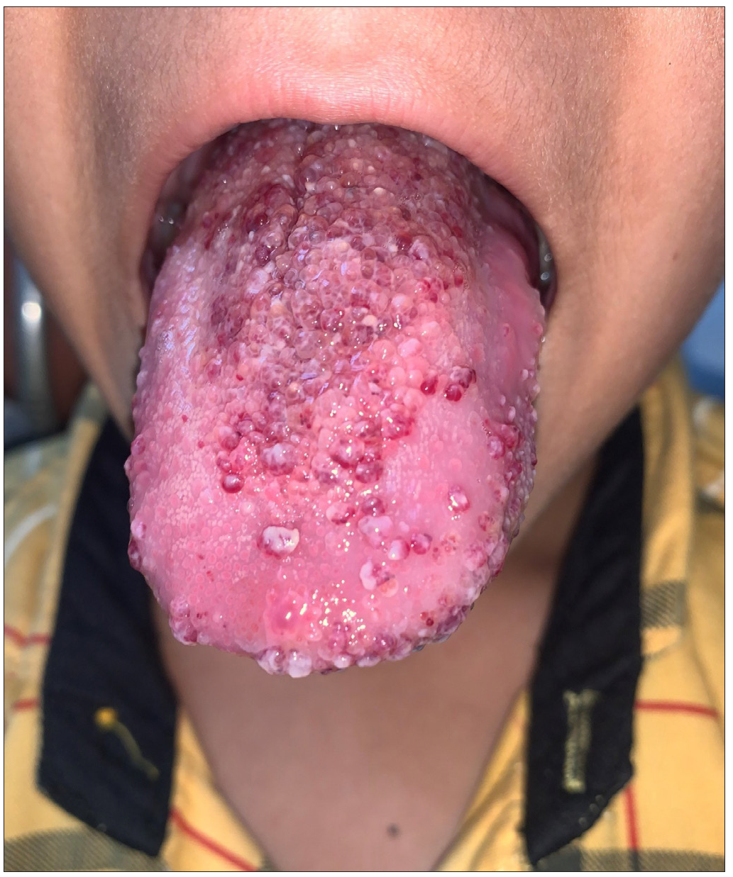 Diffuse infiltration of the tongue with multiple clear-fluid filled and haemmorhagic vesicles at baseline.