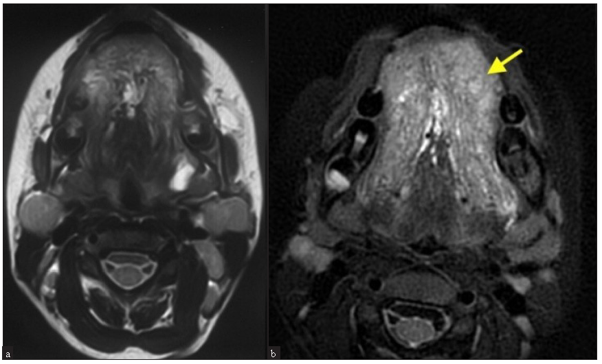 (a) MRI of the tongue at baseline (Axial view) showing mixed (microcystic and macrocystic) lymphatic malformation in the tongue. (b) At 5 months (Axial view) with a decrease in lesion size (Tongue marked with a yellow arrow).