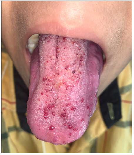 20–25% decrease in lesions after 2 months of oral sirolimus.