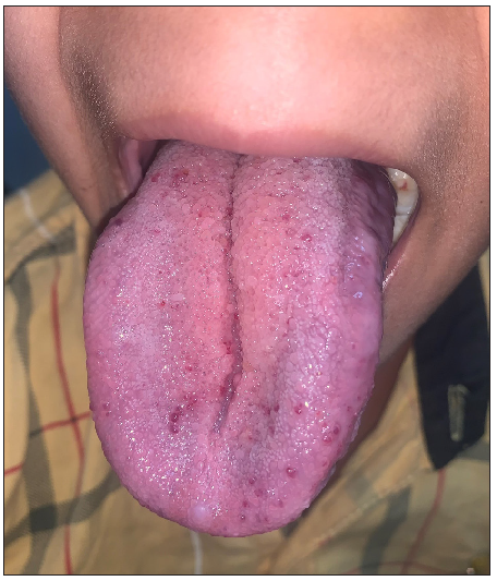 70–80% decrease in lesions after 9 months of oral sirolimus.