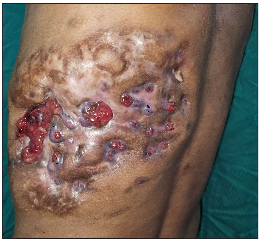 Involvement of left posterolateral thoracic wall in the form of ruptured nodules and discharging sinus with granulation tissue and black grains.