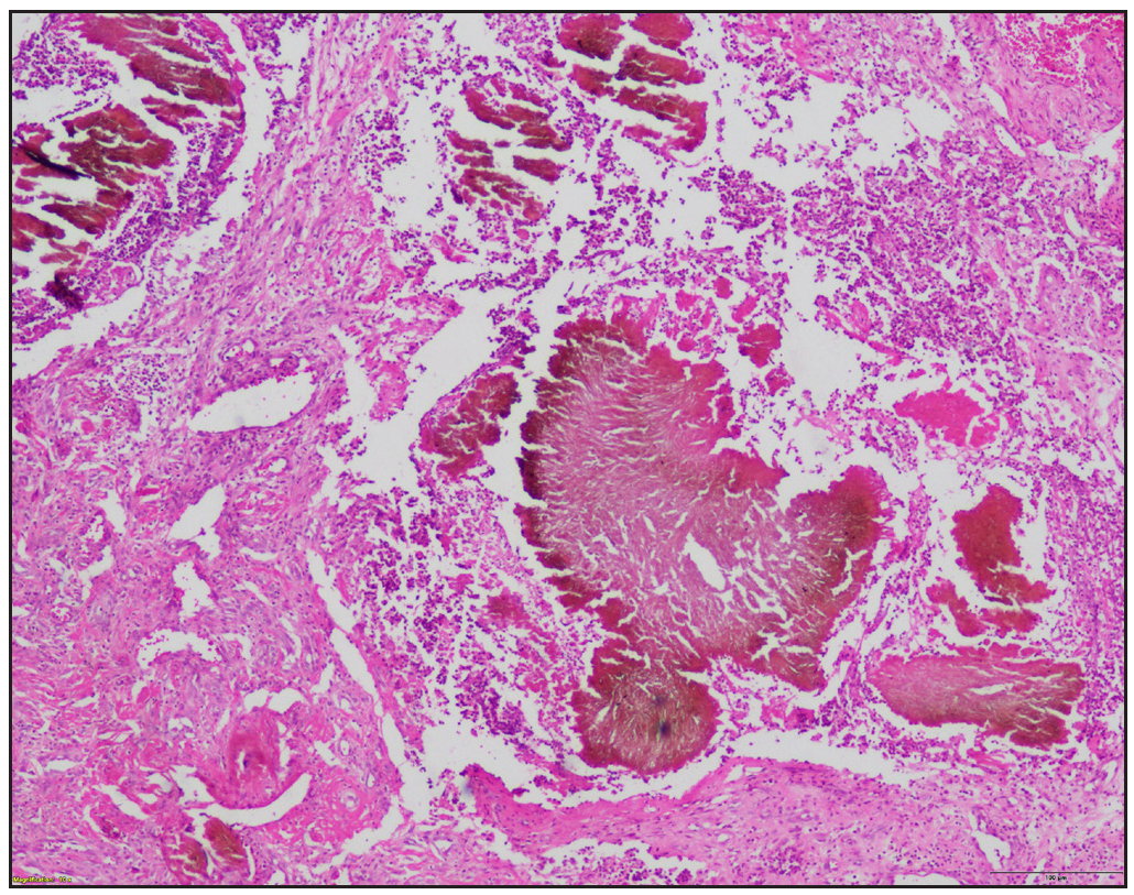 Grains with broad hyphae embedded in a brown cementum (Haematoxylin and eosin, 40x).