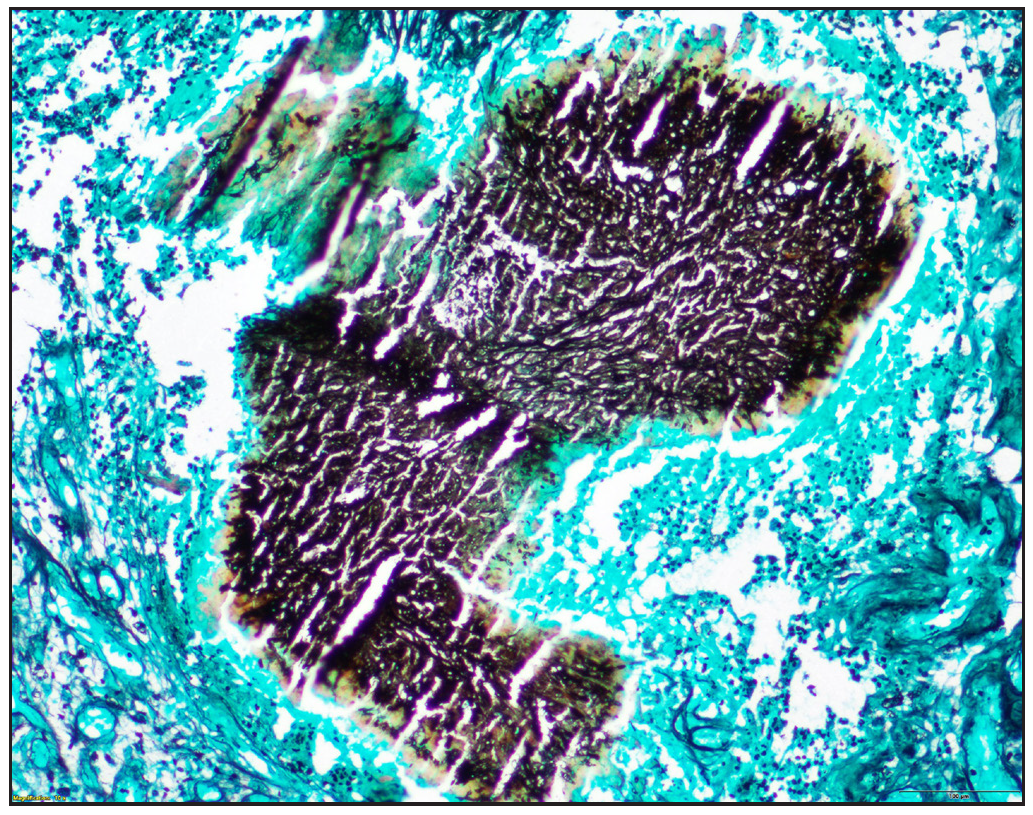 On Gomori’s methenamine silver stain, the thick fungal hyphae stained black (GMS, 100x)