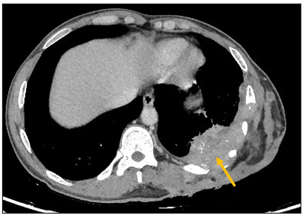 CECT axial image depicts infiltrative enhancing soft tissue lesion (yellow arrow) in the posterolateral chest wall involving the skin, subcutaneous tissue, muscles, and having contiguous intrathoracic extension; coronal mediastinal window image.