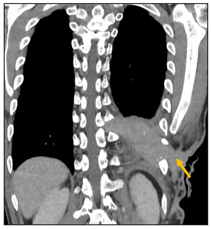 Shows the exact extent of the lesion (yellow arrow) from the skin till the chest wall; axial lung window image.