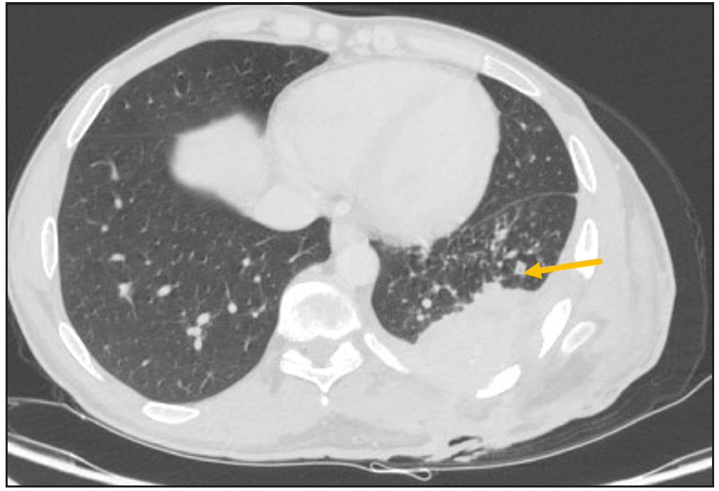 Shows minimal fibrotic changes (yellow arrow) in the adjacent lung; sagittal bone window image.