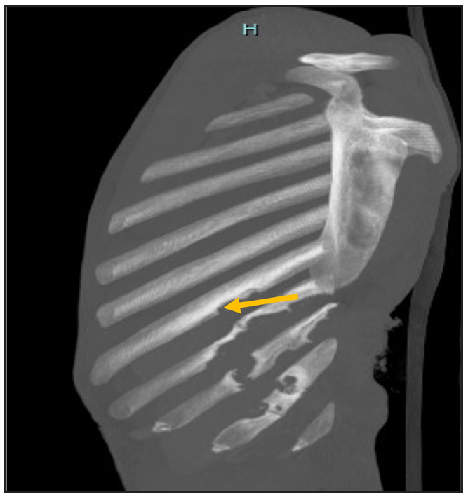 Shows erosion (yellow arrow) and sclerosis of the underlying ribs.