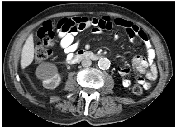 Computed tomography scan documenting the right renal mass.
