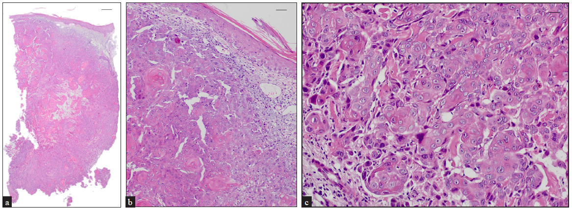 Histological appearance of a satellite lesion. (a) Atypical squamous cell proliferation infiltrating the dermis (Haematoxylin-eosin, 20x); scale bar = 500 μm. (b) Higher magnification view showcasing the invasive character of the cell proliferation Haematoxylin-eosin, 100x); scale bar = 100 μm. (c) Moderate differentiation of tumoural cells (Haematoxylin-eosin, 200x); scale bar = 50 μm.