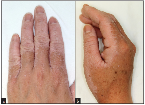 (a) Whitish spongy appearance of lesional skin was noted after a 10-minute water exposure. (b) Lateral view.