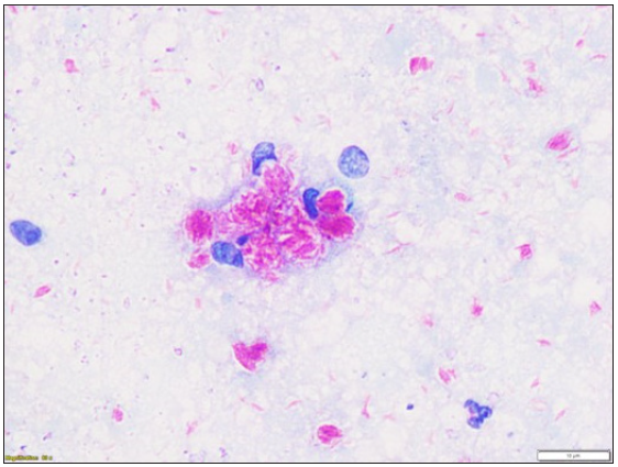 FNAC from the nodular swelling showing clumps of bacilli inside macrophages (ZN stain, 80x).