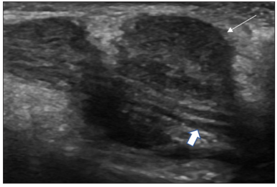 HRUS using a linear probe at 12 MHz (Logiq S8, GE Healthcare, Wisconsin, USA) revealing nodular thickening of the right radial cutaneous nerve with swollen heterogeneously hypoechoic nerve fascicles, surrounded by echogenic perineurium and epineurium (thick white arrow), focal outpouchings noted arising from the nerve (thin white arrow).