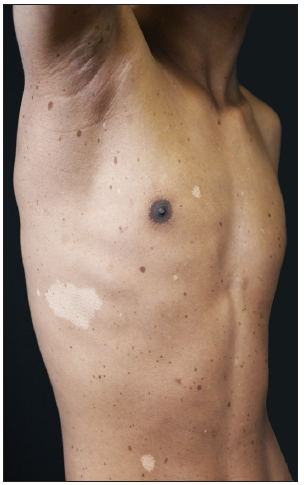 Multiple lentigines with several hypopigmented macules on the patient’s right chest.