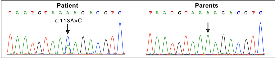 Mutation analysis in the patient and his parents. A heterozygous mutation of c.113A>C (Arrow indicated) in exon 2 of the KITLG gene was detected in the patient. His parents didn’t carry this mutation (Arrow indicated corresponding nucleotide). A, Adenosine; G, Guanine; C, Cytosine; T, Thymine.