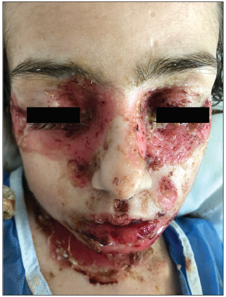 Erosions covered by haemorrhagic crusts on lips and periorbital areas.