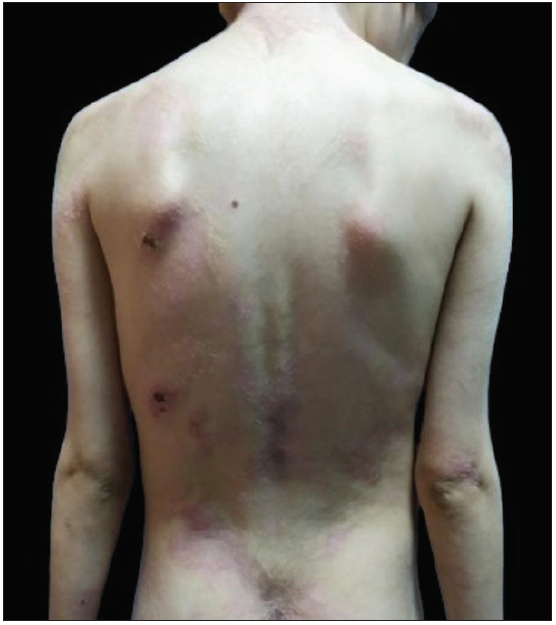 Resolution of skin lesions at 12 months post-treatment.