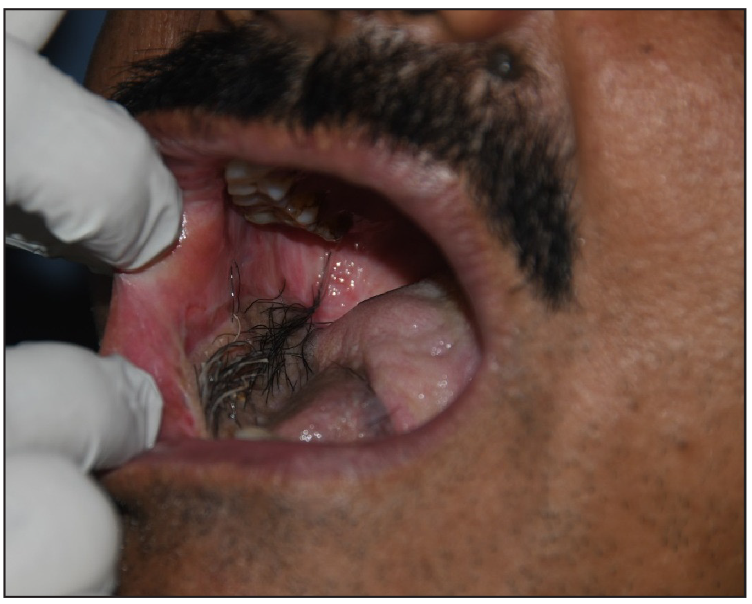 Thick terminal hair distributed over the right aspect of oral mucosa on the submental flap.