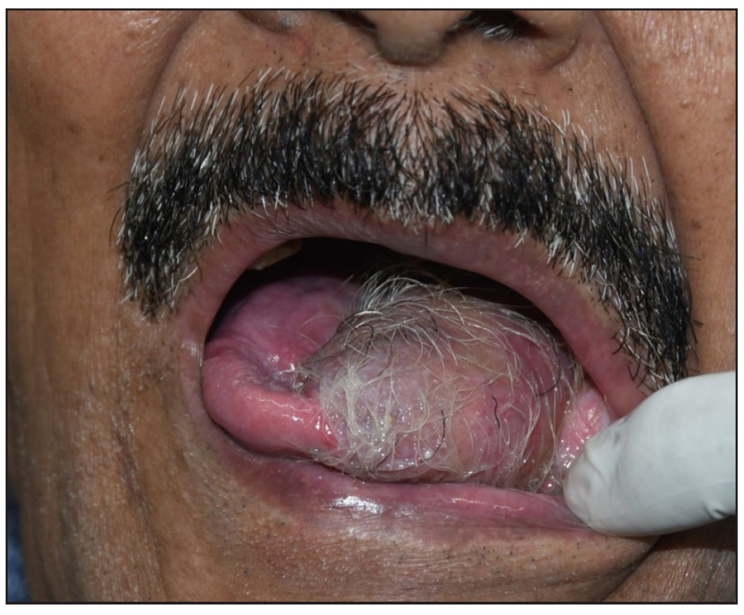 Thick terminal hair along the distribution of left lower first, second, a nd third molars over the reconstructed site with radial free flap.